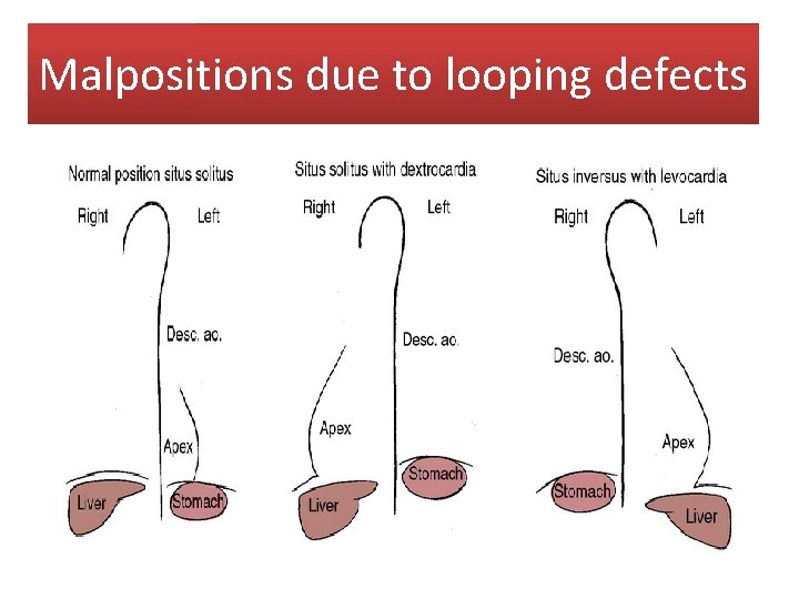 Malpositions due to looping defects 