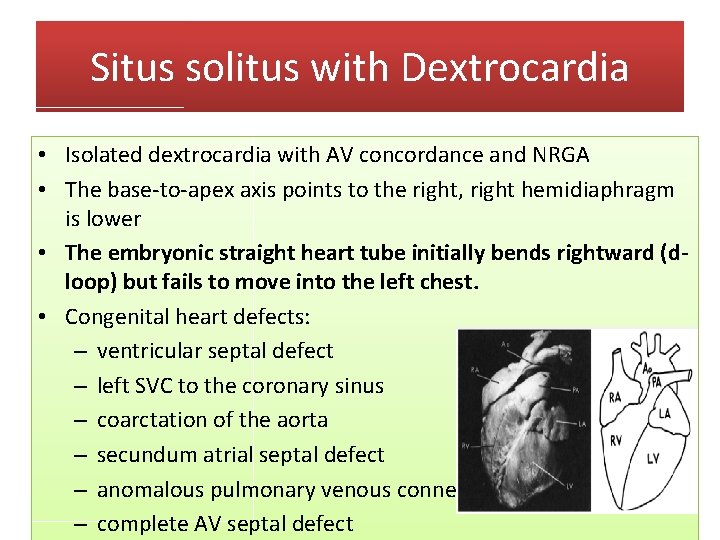Situs solitus with Dextrocardia • Isolated dextrocardia with AV concordance and NRGA • The
