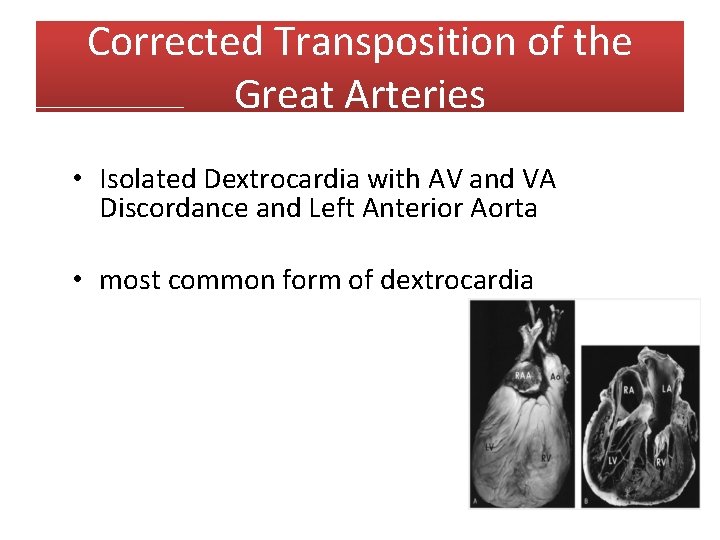 Corrected Transposition of the Great Arteries • Isolated Dextrocardia with AV and VA Discordance