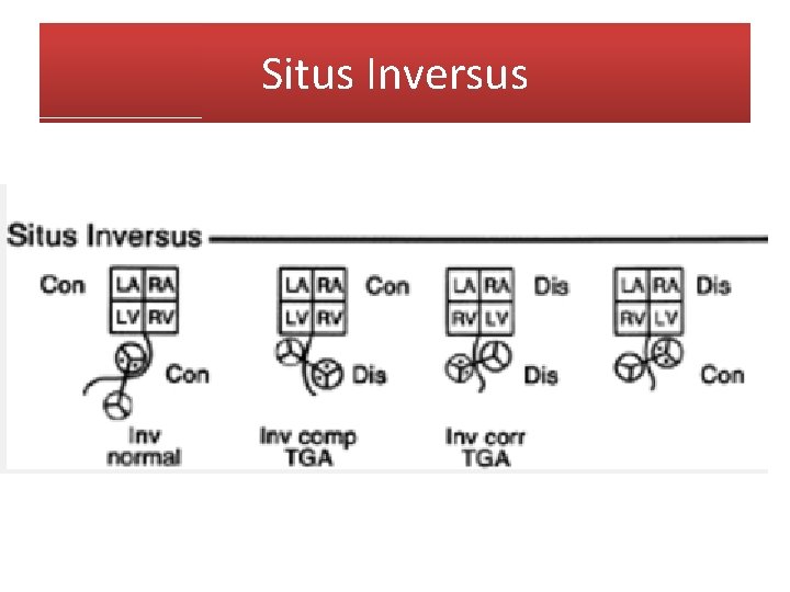Situs Inversus 