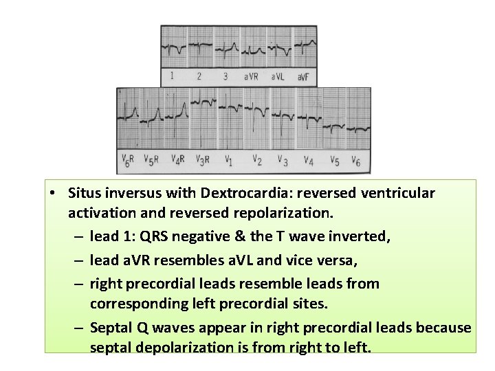 ECG • Situs inversus with Dextrocardia: reversed ventricular activation and reversed repolarization. – lead