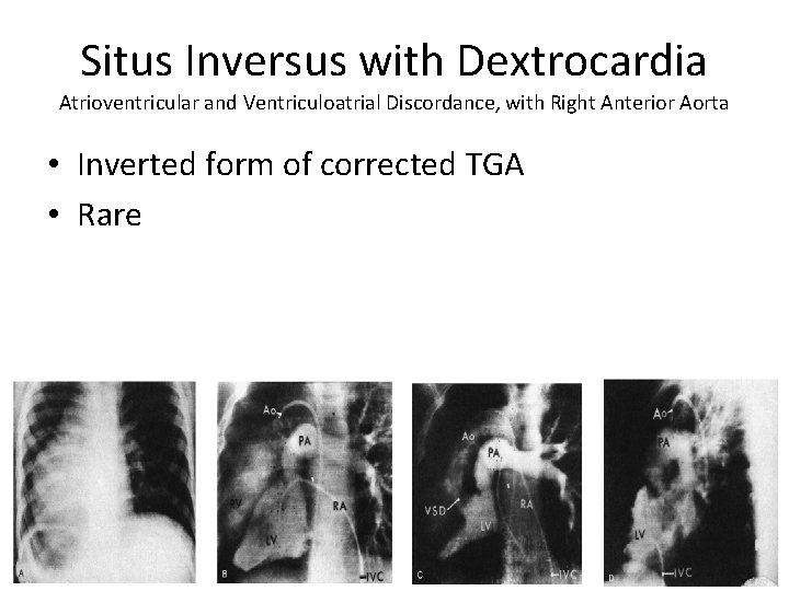 Situs Inversus with Dextrocardia Atrioventricular and Ventriculoatrial Discordance, with Right Anterior Aorta • Inverted