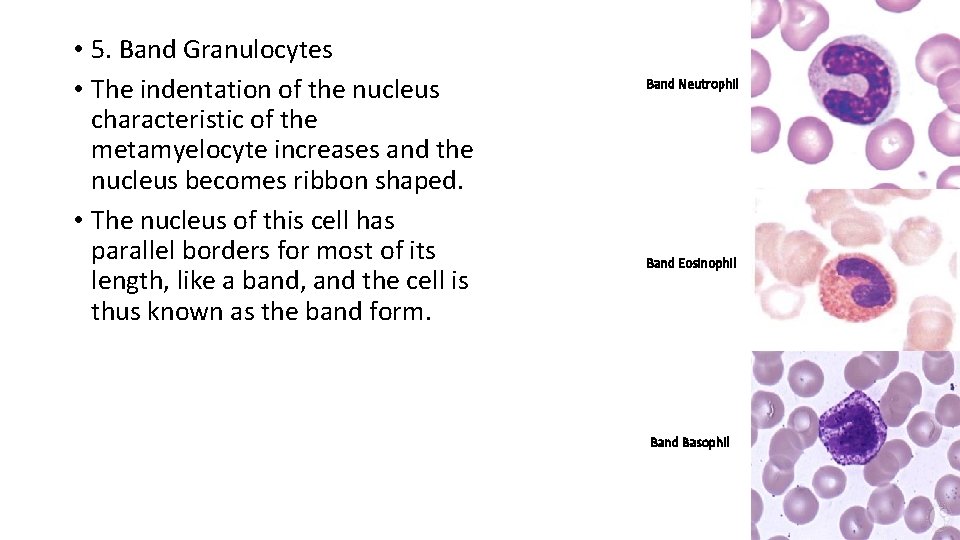  • 5. Band Granulocytes • The indentation of the nucleus characteristic of the