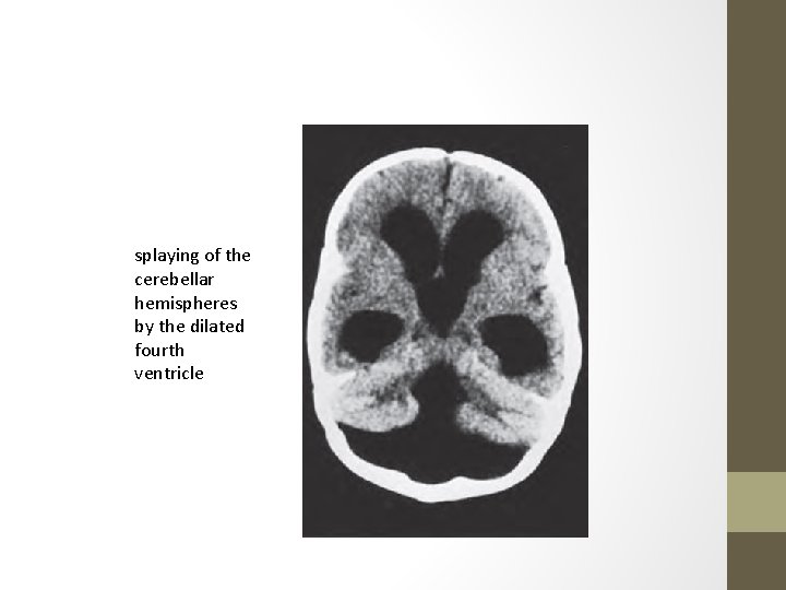 splaying of the cerebellar hemispheres by the dilated fourth ventricle 