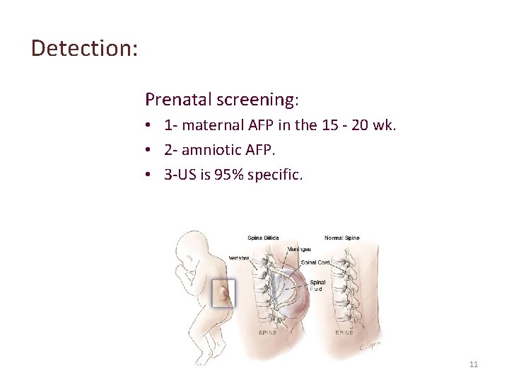 Detection: Prenatal screening: • 1 - maternal AFP in the 15 - 20 wk.