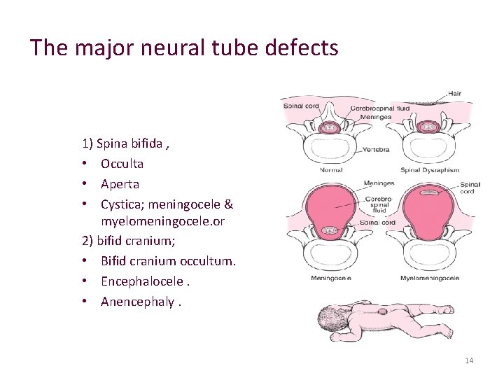 The major neural tube defects 1) Spina bifida , • Occulta • Aperta •
