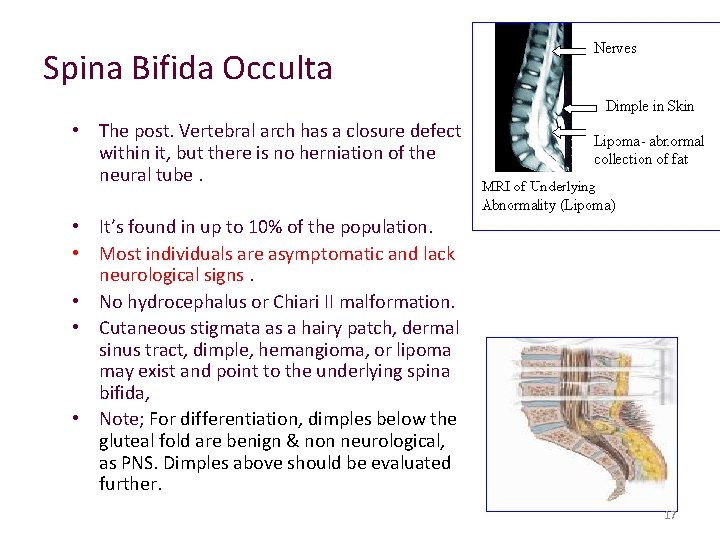 Spina Bifida Occulta • The post. Vertebral arch has a closure defect within it,