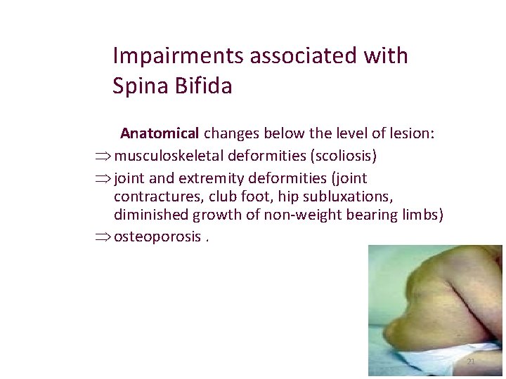 Impairments associated with Spina Bifida Anatomical changes below the level of lesion: Þ musculoskeletal