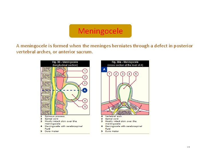 Meningocele A meningocele is formed when the meninges herniates through a defect in posterior