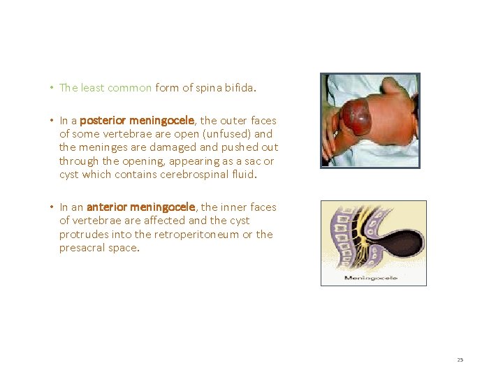  • The least common form of spina bifida. • In a posterior meningocele,