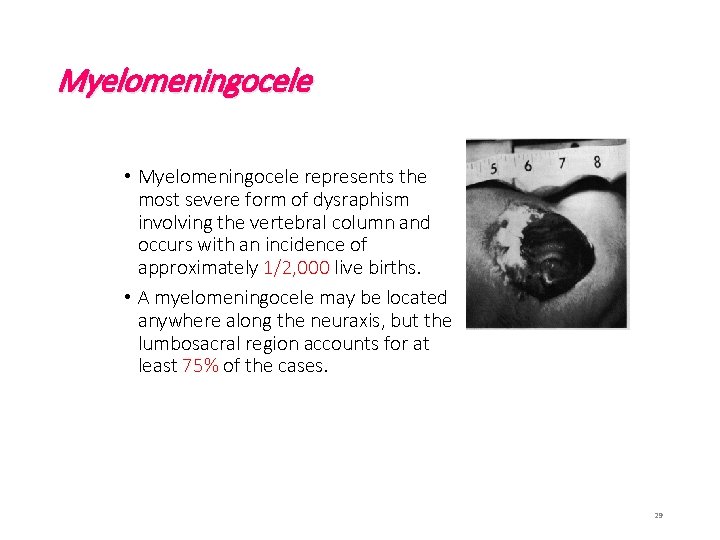 Myelomeningocele • Myelomeningocele represents the most severe form of dysraphism involving the vertebral column