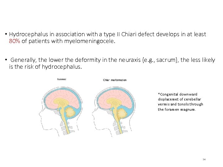  • Hydrocephalus in association with a type II Chiari defect develops in at