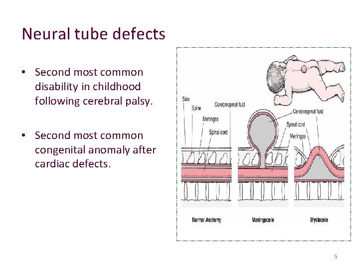 Neural tube defects • Second most common disability in childhood following cerebral palsy. •