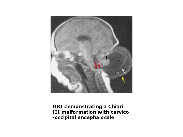 MRI demonstrating a Chiari III malformation with cervico -occipital encephalocele 