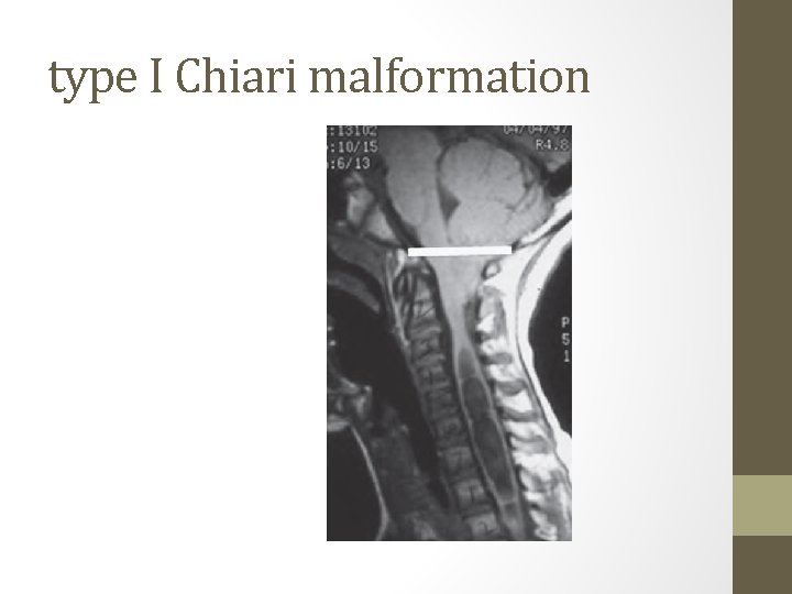 type I Chiari malformation 