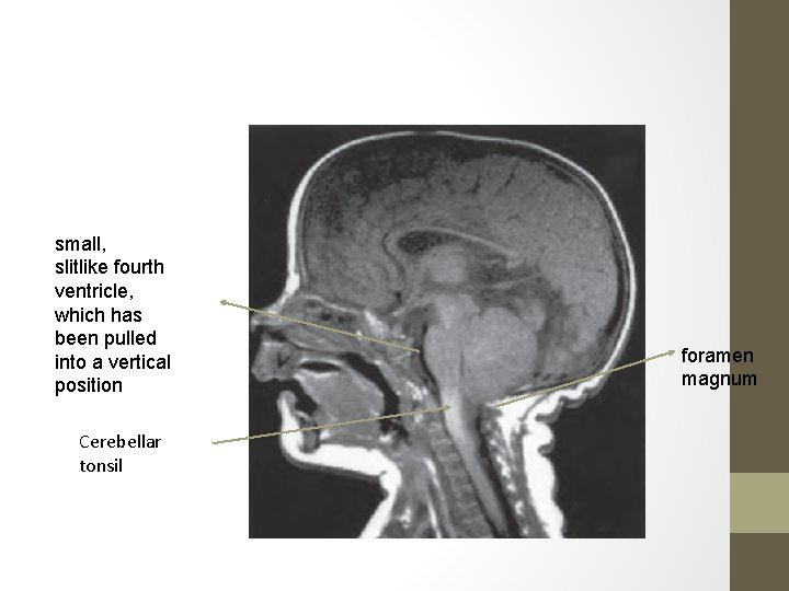 small, slitlike fourth ventricle, which has been pulled into a vertical position Cerebellar tonsil