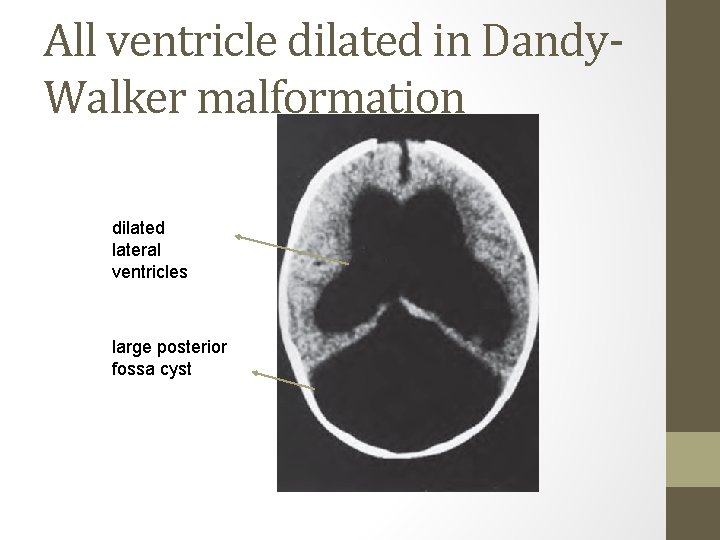 All ventricle dilated in Dandy. Walker malformation dilated lateral ventricles large posterior fossa cyst