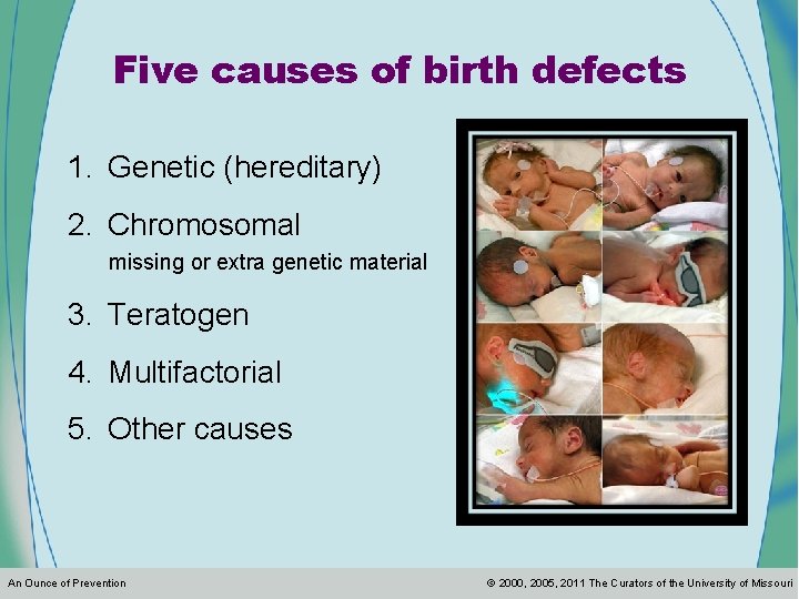 Five causes of birth defects 1. Genetic (hereditary) 2. Chromosomal missing or extra genetic