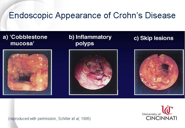 Endoscopic Appearance of Crohn’s Disease (reproduced with permission, Schiller et al, 1986) 