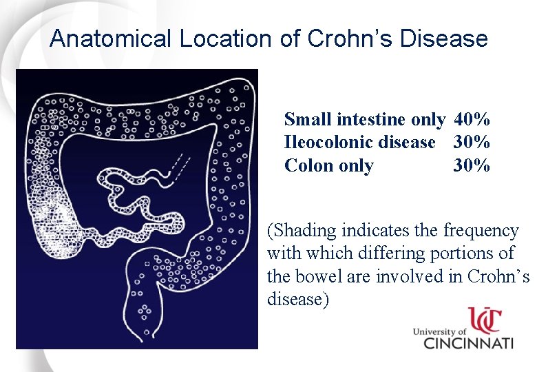 Anatomical Location of Crohn’s Disease Small intestine only 40% Ileocolonic disease 30% Colon only