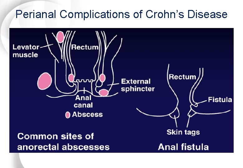Perianal Complications of Crohn’s Disease 