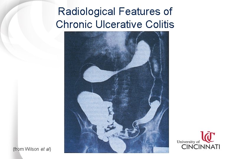 Radiological Features of Chronic Ulcerative Colitis (from Wilson et al) 