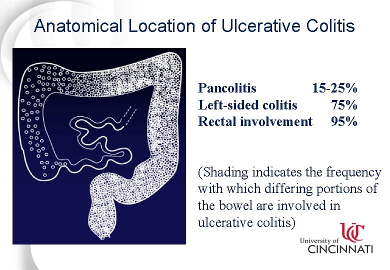 Anatomical Location of Ulcerative Colitis Pancolitis 15 -25% Left-sided colitis 75% Rectal involvement 95%