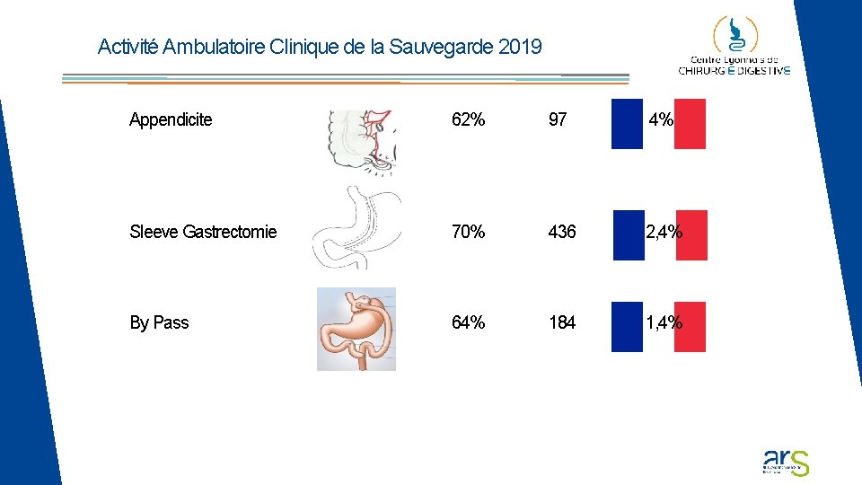 Activité Ambulatoire Clinique de la Sauvegarde 2019 Appendicite 62% 97 4% Sleeve Gastrectomie 70% Activité Ambulatoire Clinique de la Sauvegarde 2019 Appendicite 62% 97 4% Sleeve Gastrectomie 70%