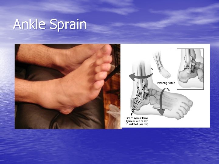 Ankle Sprain 