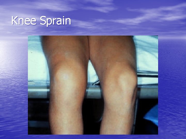 Knee Sprain 