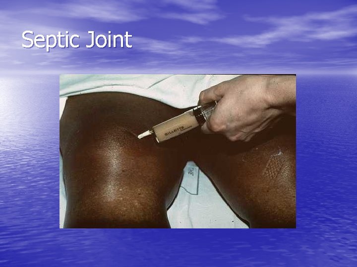 Septic Joint 