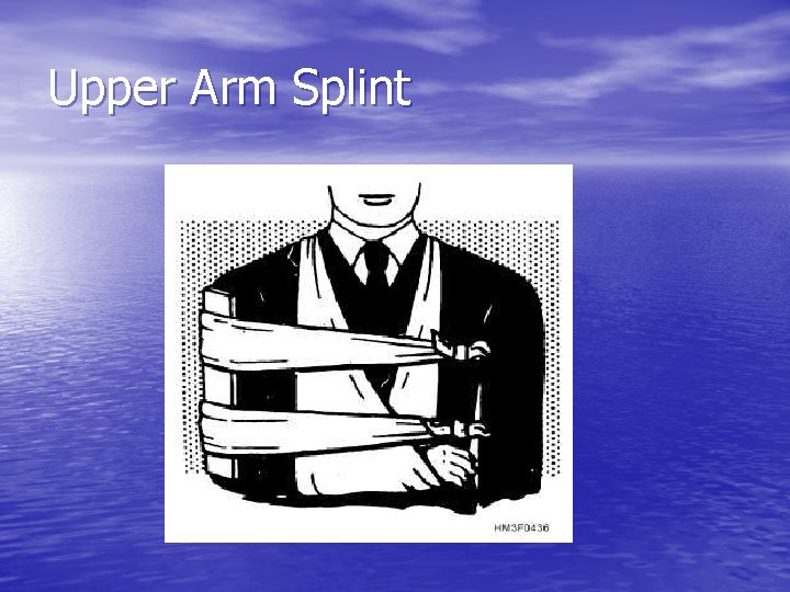 Upper Arm Splint 