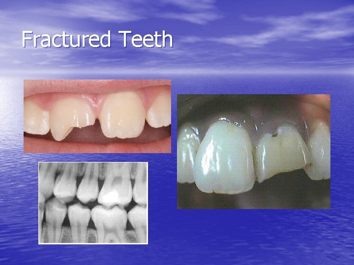 Fractured Teeth 