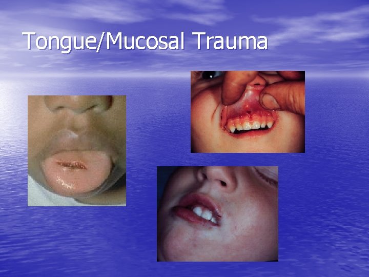 Tongue/Mucosal Trauma 