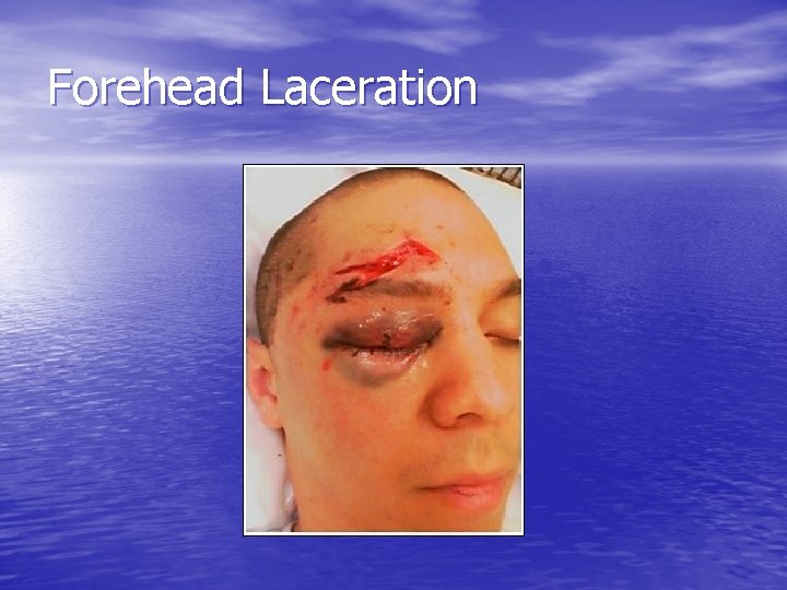Forehead Laceration 