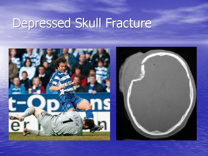 Depressed Skull Fracture 