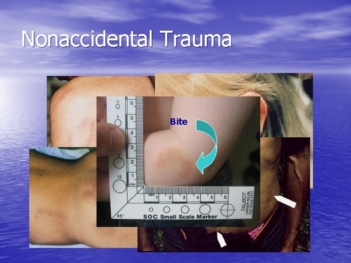 Nonaccidental Trauma Bite 