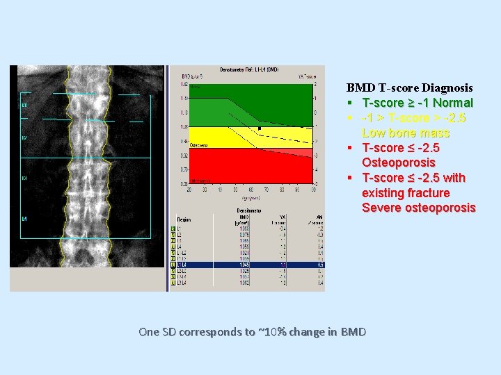 BMD T-score Diagnosis § T-score ≥ -1 Normal § -1 > T-score > -2.