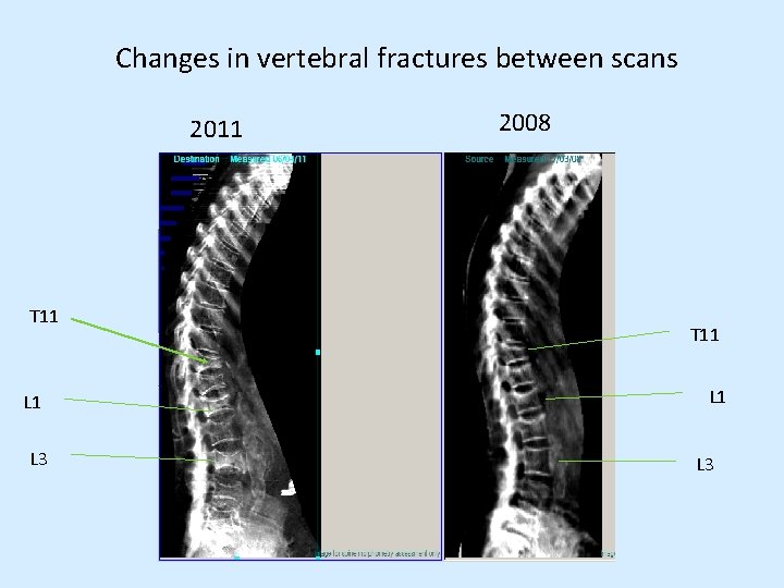 Changes in vertebral fractures between scans 2011 T 11 L 3 2008 T 11