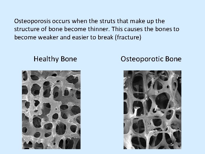 Osteoporosis occurs when the struts that make up the structure of bone become thinner.