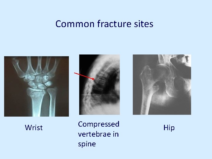 Common fracture sites Wrist Compressed vertebrae in spine Hip 