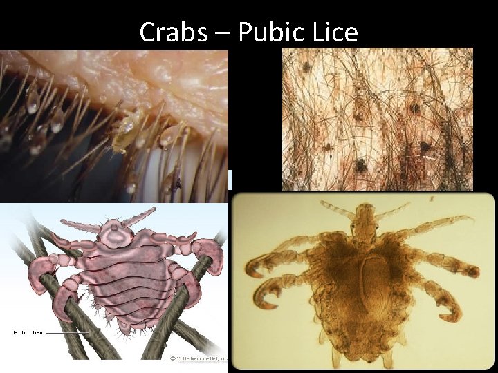 Crabs – Pubic Lice 