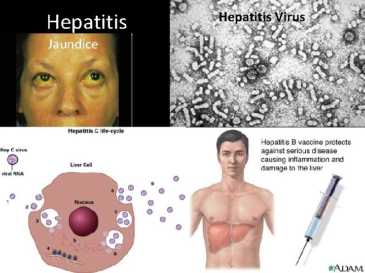 Hepatitis Jaundice Hepatitis Virus 