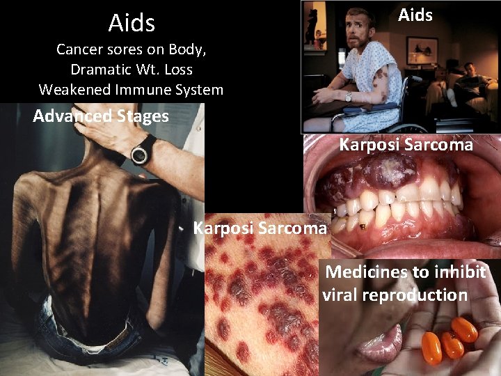 Aids Cancer sores on Body, Dramatic Wt. Loss Weakened Immune System Advanced Stages Karposi