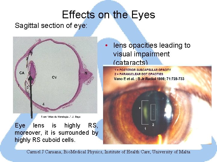 Effects on the Eyes Sagittal section of eye: • lens opacities leading to visual