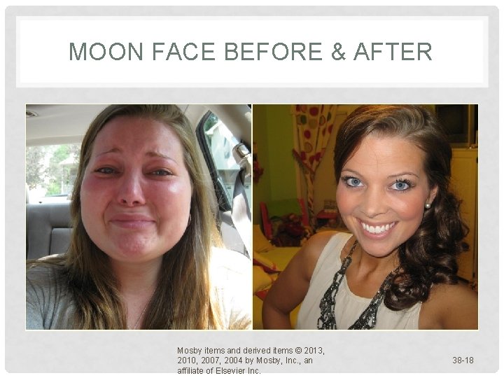 MOON FACE BEFORE & AFTER Mosby items and derived items © 2013, 2010, 2007, MOON FACE BEFORE & AFTER Mosby items and derived items © 2013, 2010, 2007,