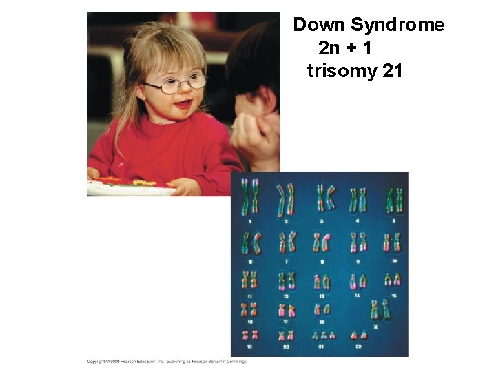 Down Syndrome 2 n + 1 trisomy 21 