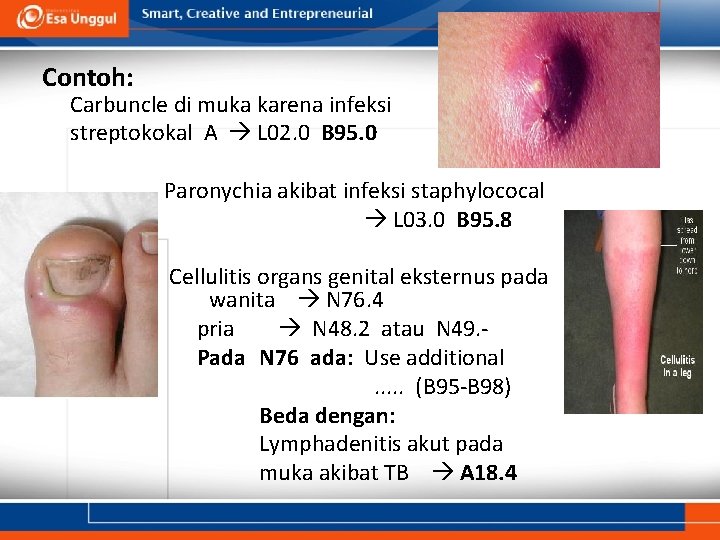 Contoh: Carbuncle di muka karena infeksi streptokokal A L 02. 0 B 95. 0