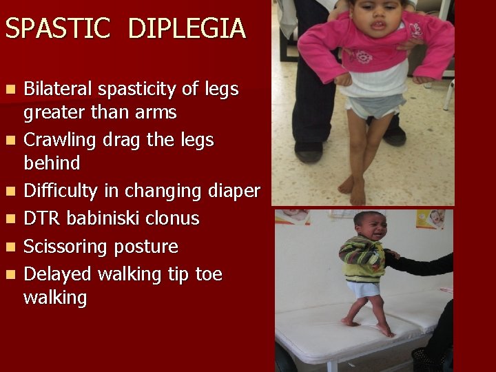SPASTIC DIPLEGIA n n n Bilateral spasticity of legs greater than arms Crawling drag