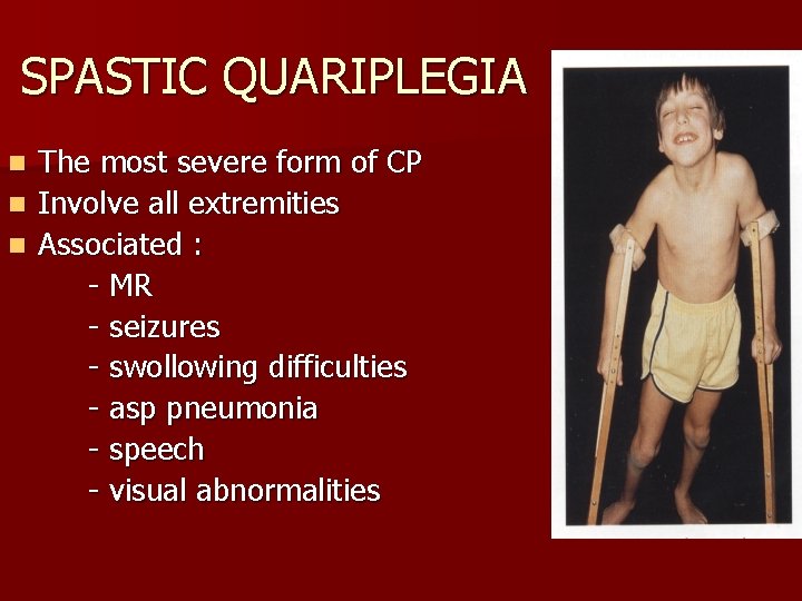 SPASTIC QUARIPLEGIA The most severe form of CP n Involve all extremities n Associated